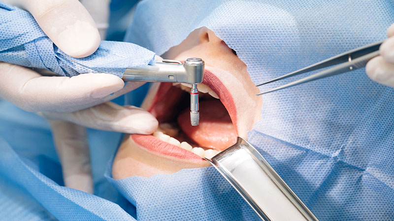 مراحل کاشت ایمپلنت دندان چگونه است؟