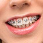 درمان ارتودنسی ثابت