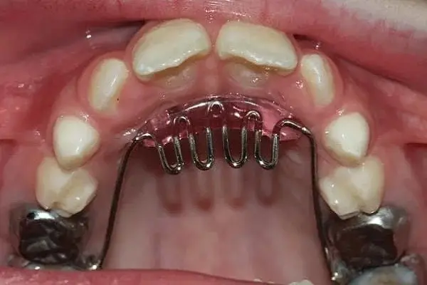 لوازم کنترل مکیدن انگشت 