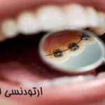 ارتودنسی لینگوال