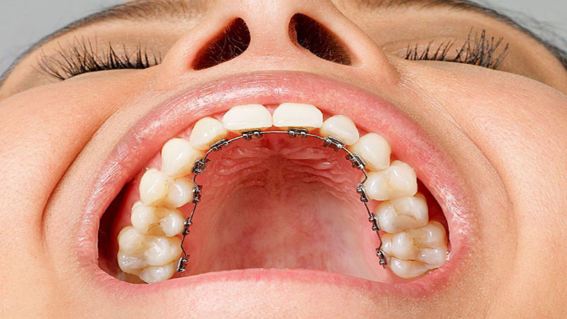 ارتودنسی پشت دندانی