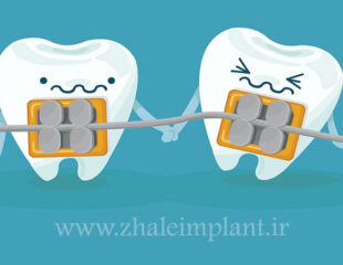 لق شدن دندان در طول ارتودنسی