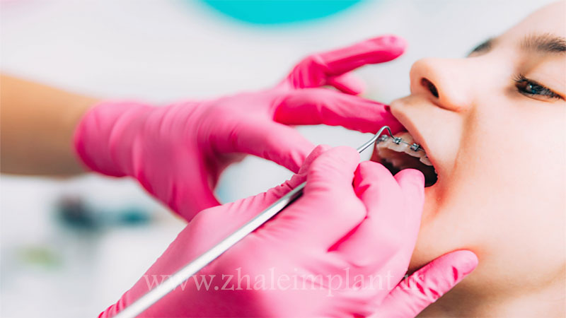 علت لق شدن دندان در ارتودنسی