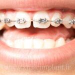 ارتودنسی فک بالا