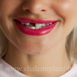 انواع روش های کاشت دندان