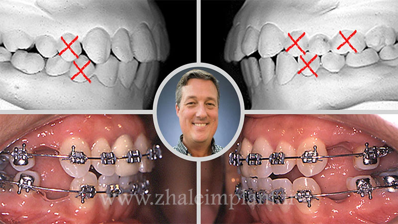 کشیدن دندان در طول درمان ارتودنسی