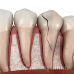 شکستگی دندان