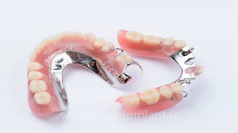 دندان مصنوعی پارسیل پایه فلز
