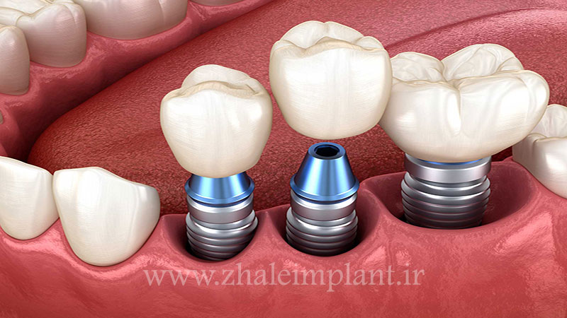 ایمپلنت دندان بهترین جایگزین برای دندان از دست رفته