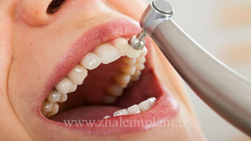 تمیز کردن حرفه ای دندان