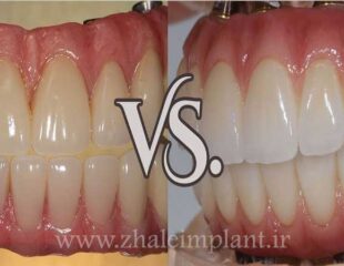 دندان مصنوعی سرامیکی بهتر است یا اکریلیکی؟
