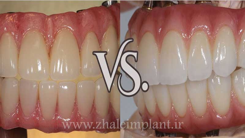 دندان مصنوعی سرامیکی بهتر است یا اکریلیکی؟