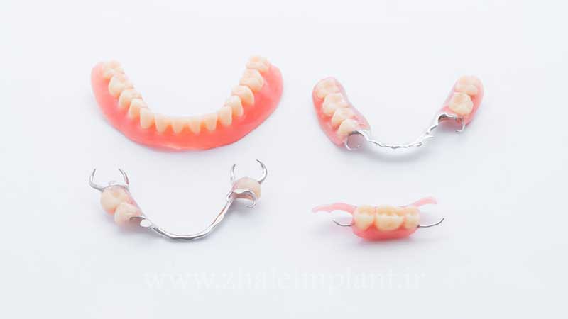 دندان مصنوعی سرامیکی بهتر است یا اکریلیکی