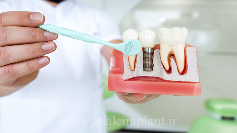 تخصص در دندانپزشکی ایمپلنت