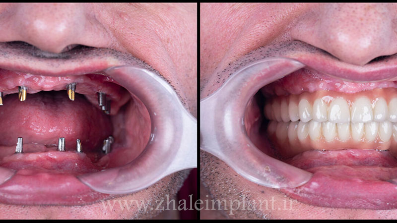ایمپلنت کامل دندان چیست؟