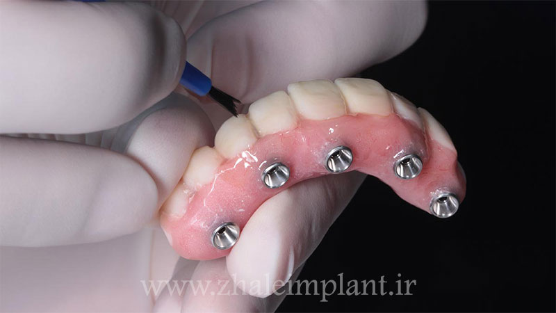 نصب رابط ایمپلنت کامل دندان