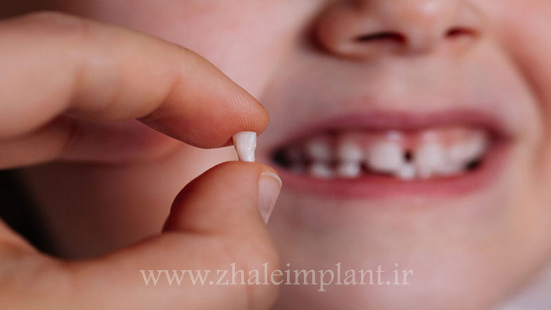 هزینه دندانپزشکی کودکان بر اساس نوع دندان