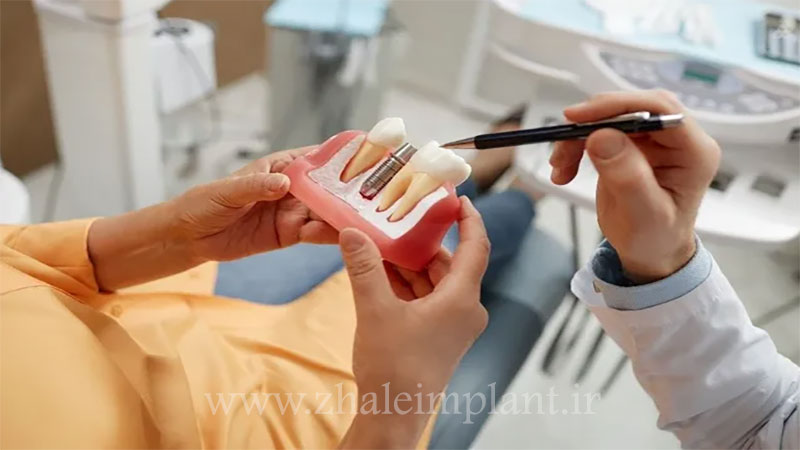 محدودیت های بعد از ایمپلنت دندان