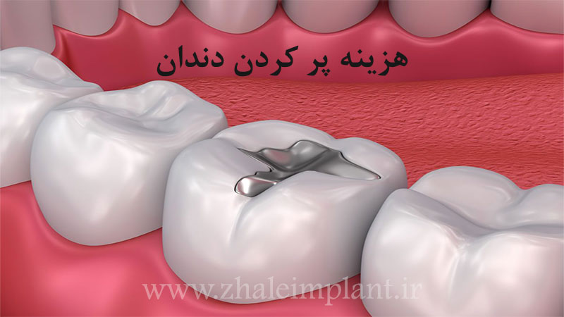 هزینه پر کردن دندان 1403