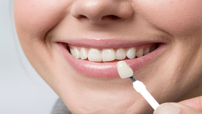 هدف از تراش دندان برای لمینت