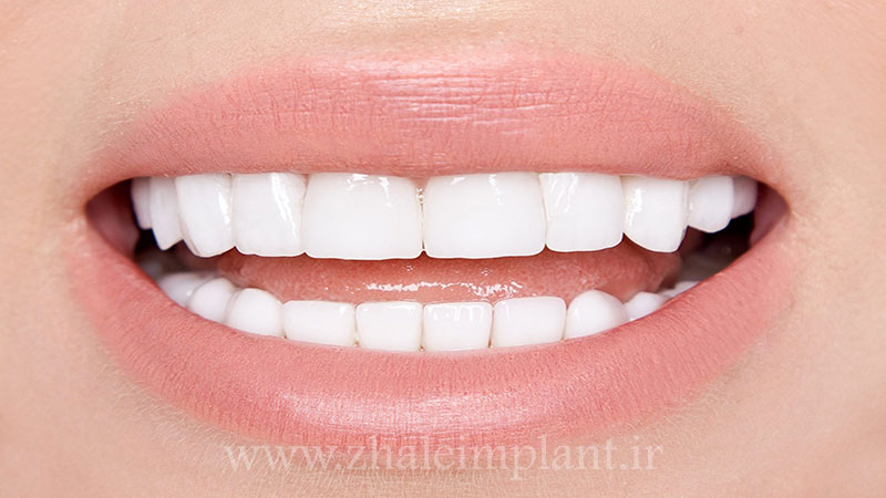 میزان تراش دندان برای لمینت دندان