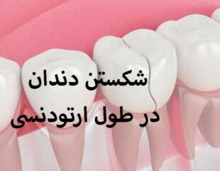 شکستن دندان در طول ارتودنسی