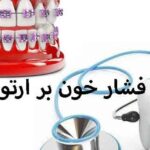 تاثیر فشار خون بر ارتودنسی