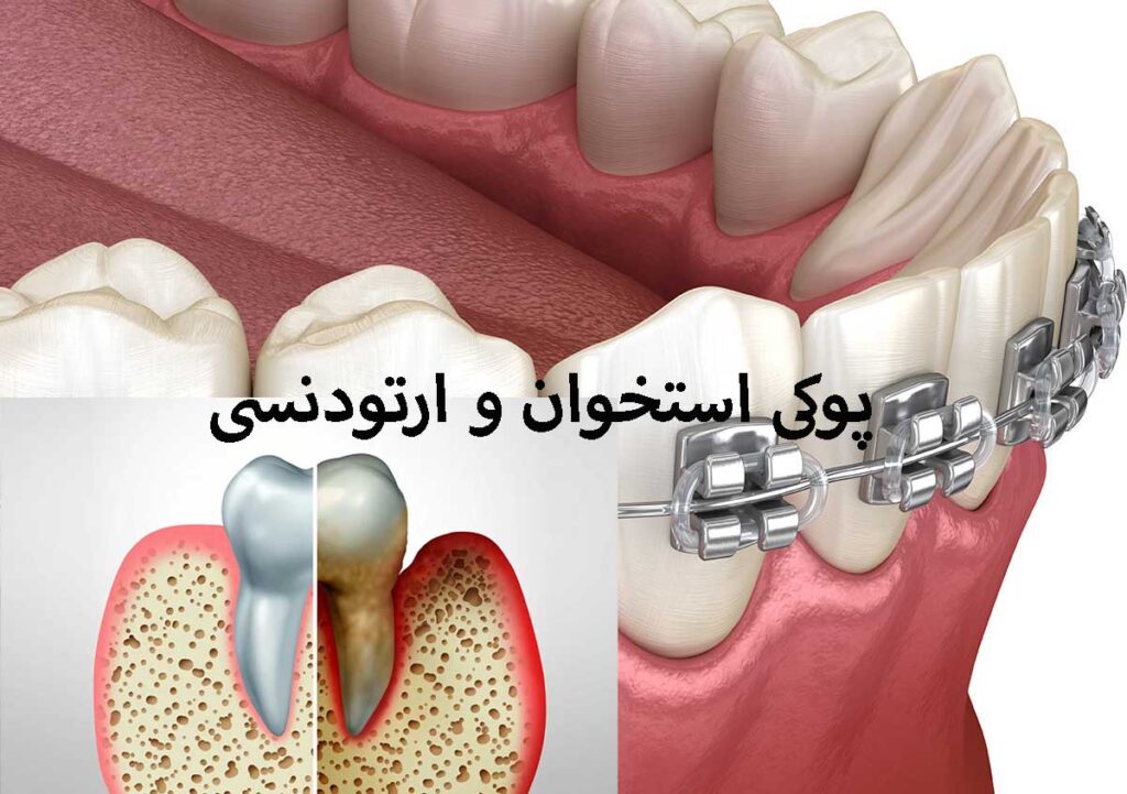 پوکی استخوان و ارتودنسی