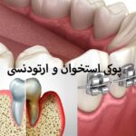 پوکی استخوان و ارتودنسی