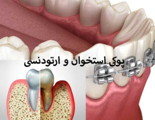 پوکی استخوان و ارتودنسی