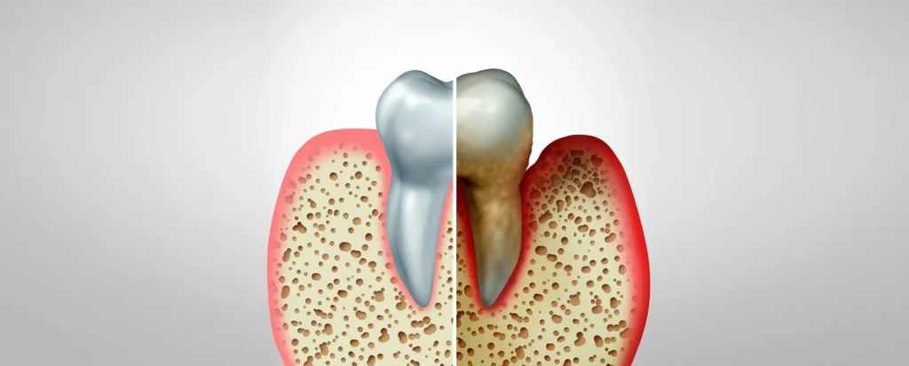 پوکی استخوان فک