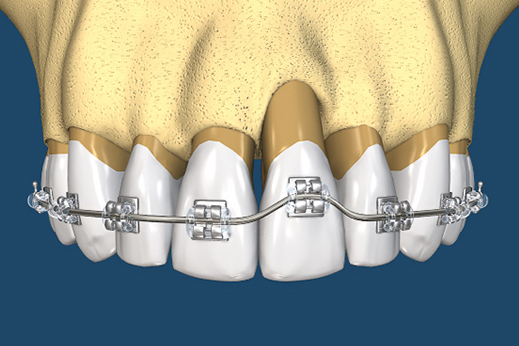 پیوند استخوان در ارتودنسی