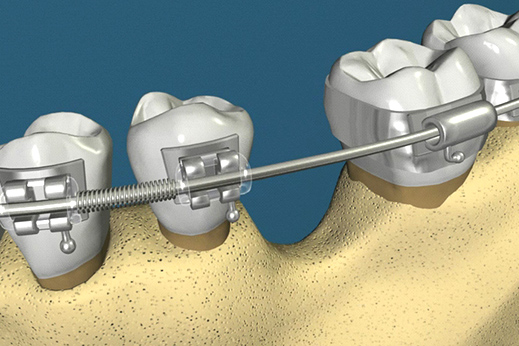 پوکی استخوان و ارتودنسی