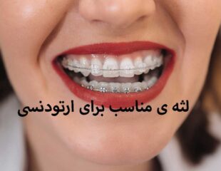 لثه ی مناسب برای ارتودنسی